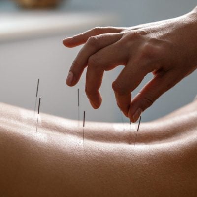 Acupuncture Therapy Near me