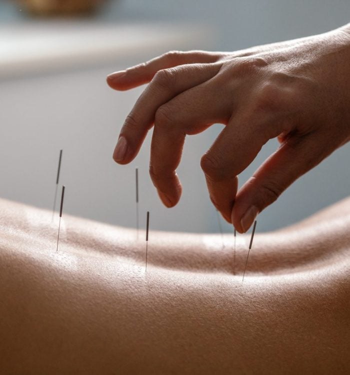 Acupuncture Therapy Near me